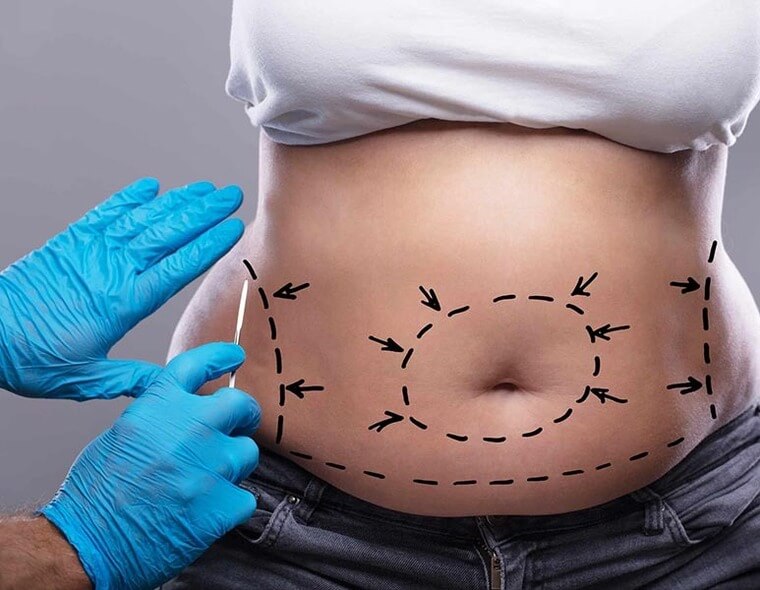 Cirurgião plastico desenhando as medidas nas barriga da paciente antes da abdominoplastia.