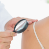 O que é melanoma? Sintomas e tratamento